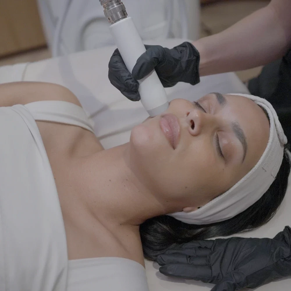 T-Shape 2 facial treatment on the cheek at iCRYO Marietta