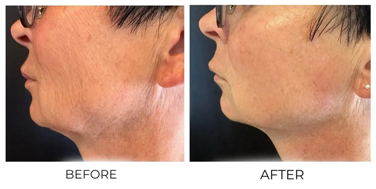 Face & Neck before and after results